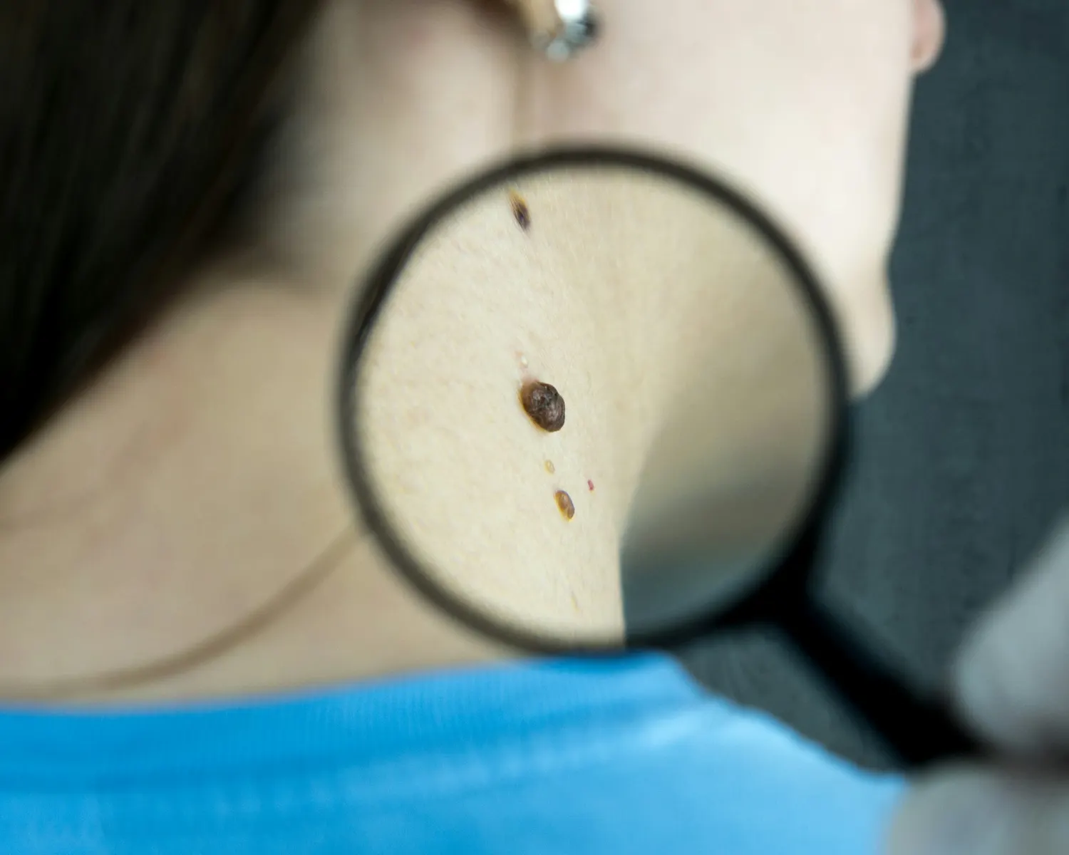 A mole on the skin examined closely through a magnifying glass